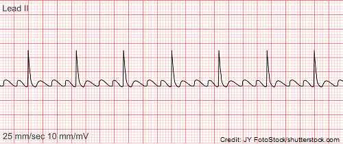 Atrial Arrhythmias are&nbsp;Awesome