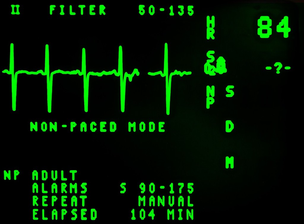 A hospitals ECG monitor with patient vitals and heart rate showing. 