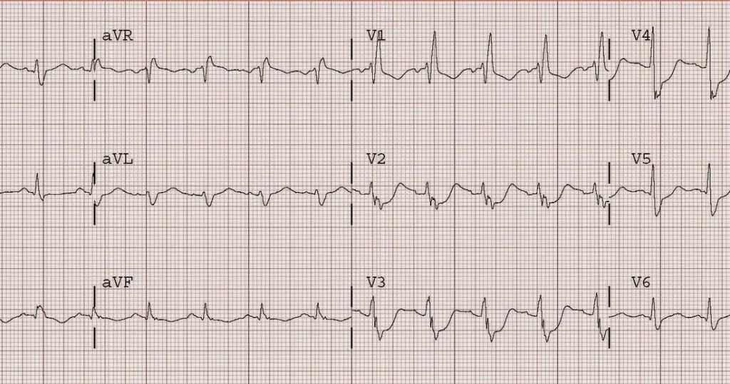 An image of a Posterior MI on an ECG Strip

