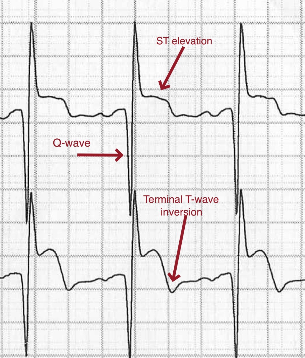 The Best Way To Get Started Learning About ECGs For Paramedic Class For&nbsp;Beginners